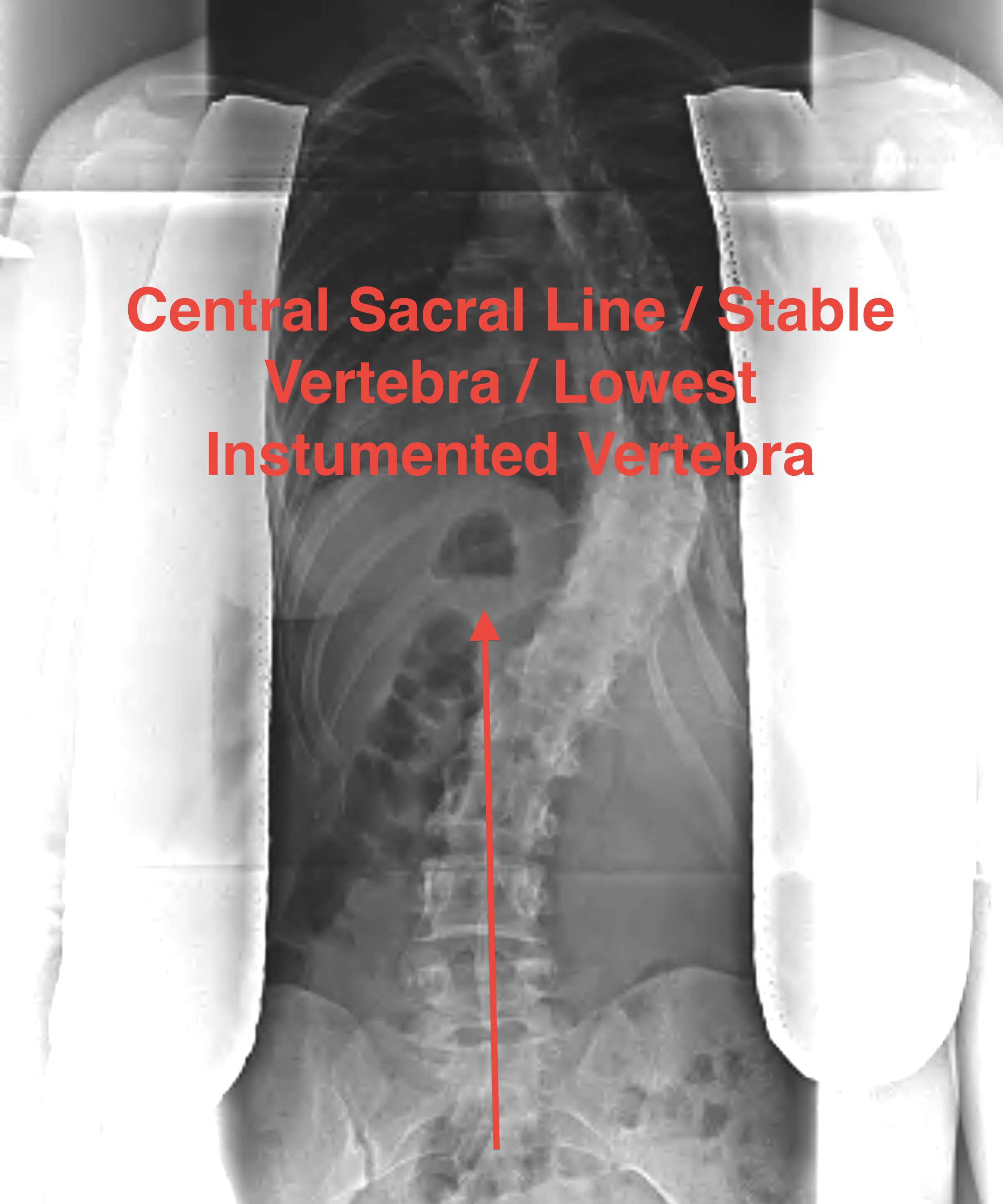 Scoliosis Central Sacral Line